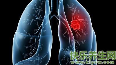肺癌前期的5大症状！